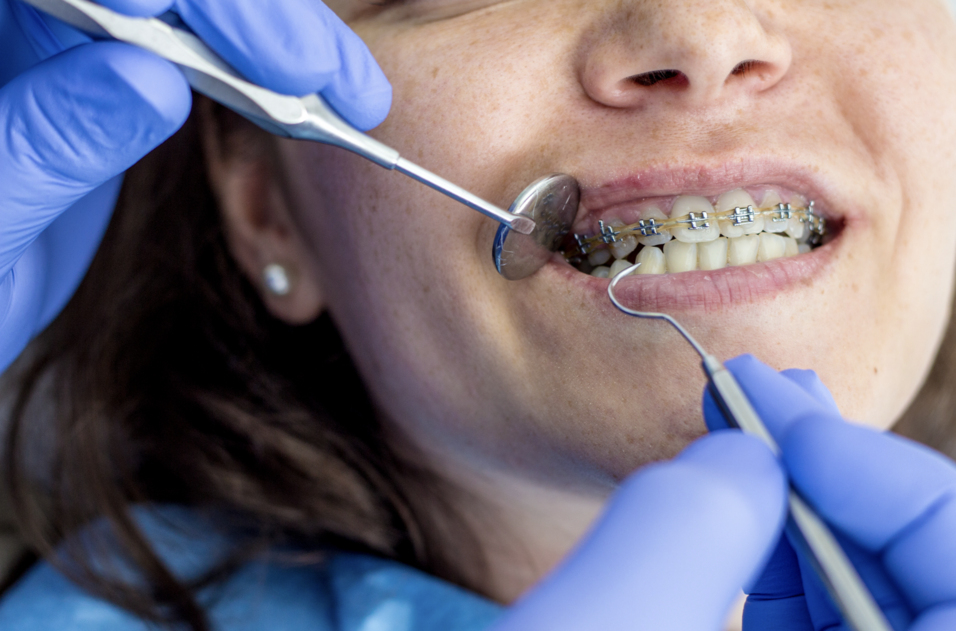 diş teli tedavisi nasıl yapılır